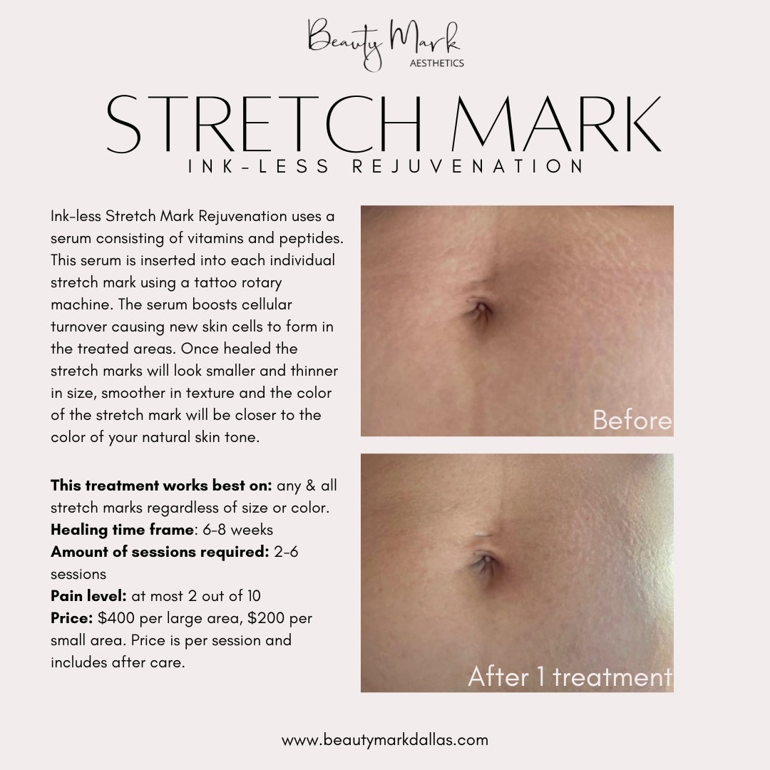 Heal your stretch marks - by color